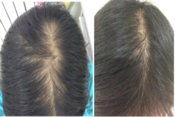 止脱生发加盟费