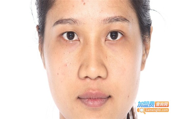 若水缘专业祛痘加盟费