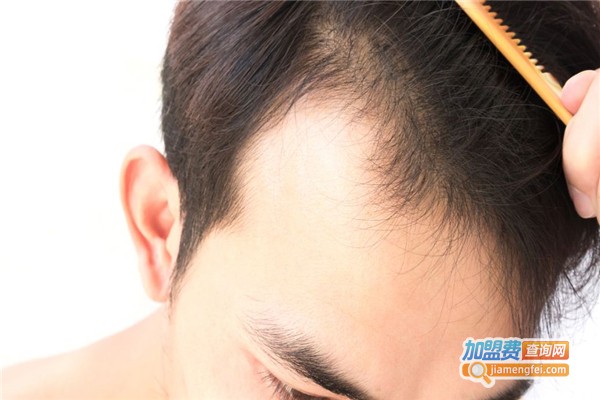 惠民植发加盟费