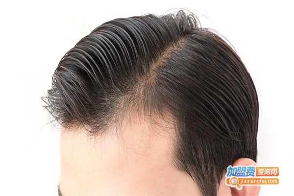 惠民植发加盟费