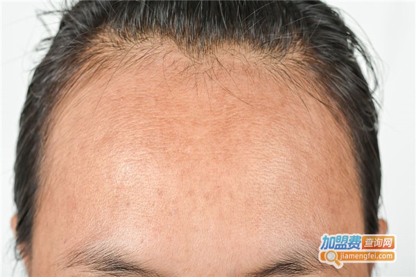 惠民植发加盟费