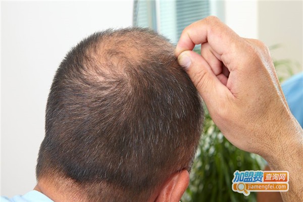 科发源植发加盟费