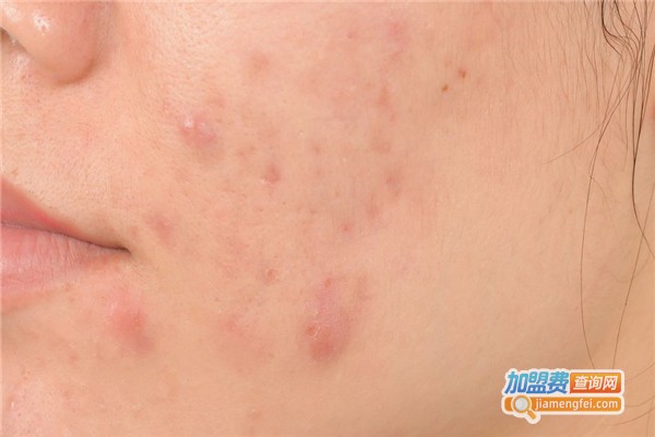 5+5疤痕医生加盟费