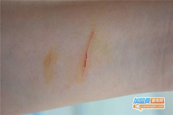 5+5疤痕医生加盟费