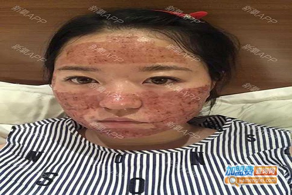 芳草地黛专业祛痘加盟门店