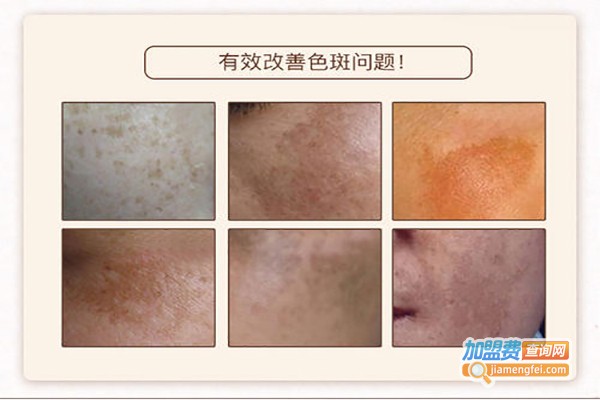 芙琳美轩祛斑加盟费