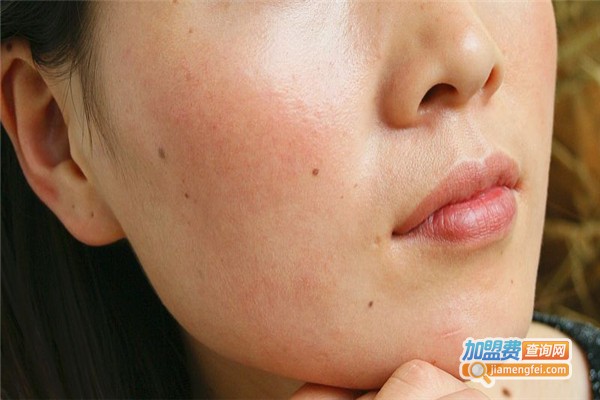 祛斑美容产品加盟费