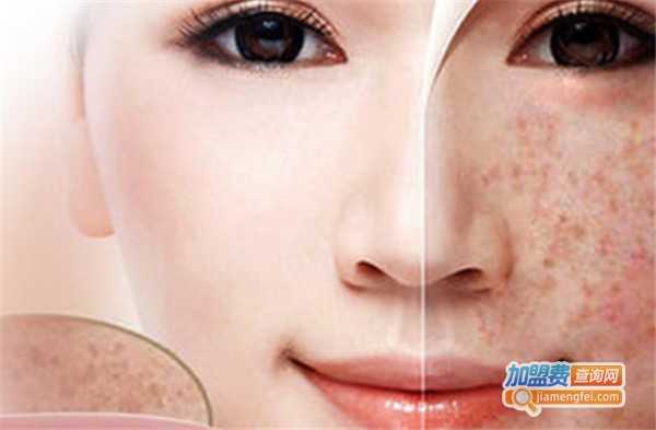 诗淇美颜祛斑加盟