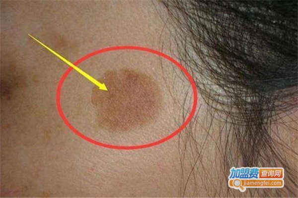 斑美拉祛斑加盟费