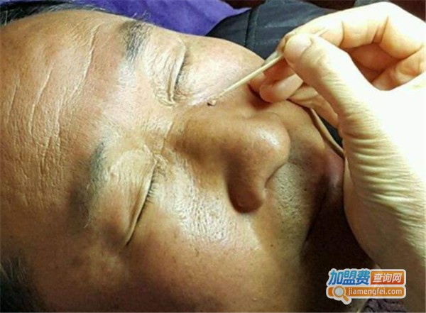 朱氏祖传中药点痣加盟费