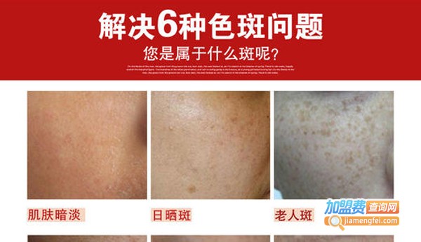 斑无踪祛斑加盟