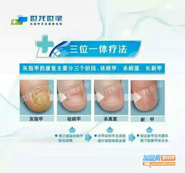 世龙世家灰指甲加盟