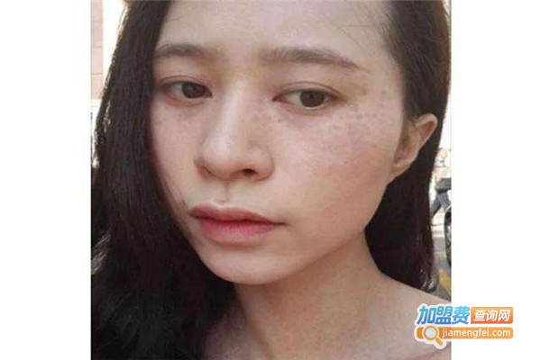 皮肤祛斑加盟费