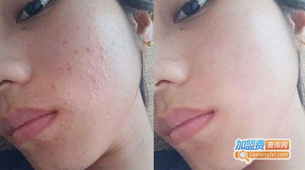肤原祛痘