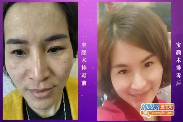 宝颜术祛斑加盟