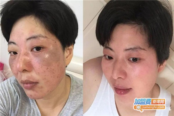 泓源鑫祛斑加盟