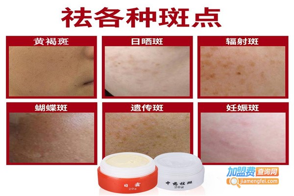 泓源鑫祛斑加盟