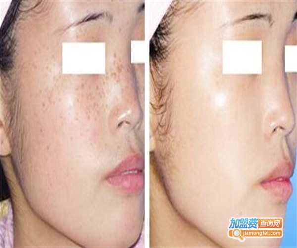 倩薇娜祛斑加盟费