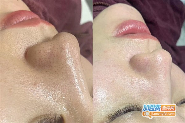 八叶莲华毛囊清洁加盟