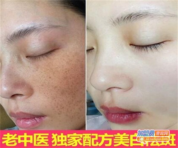 倩薇娜祛斑加盟费