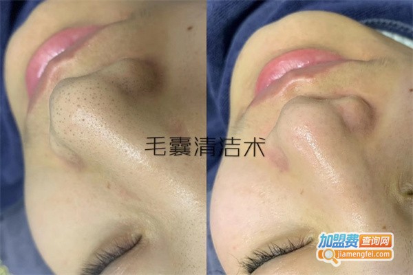 八叶莲华毛囊清洁加盟费