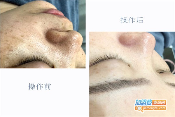 八叶莲华毛囊清洁