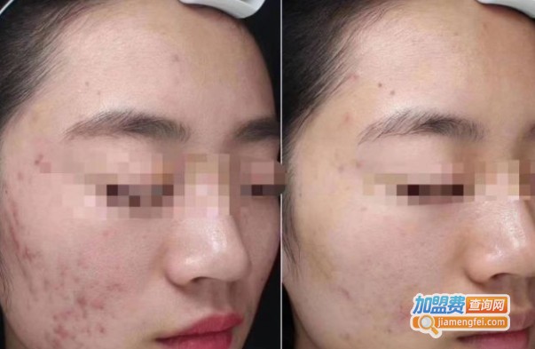 澜思菲娅祛斑祛痘中心加盟费