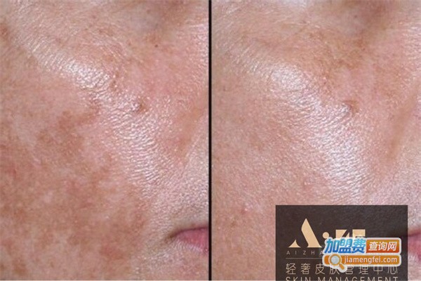 爱绽放皮肤管理加盟费