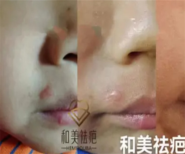 和美疤痕修复加盟费