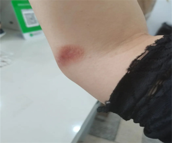 和美疤痕修复加盟费