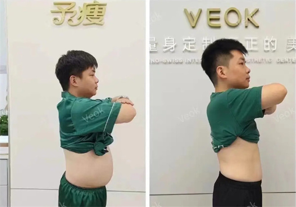 予瘦
