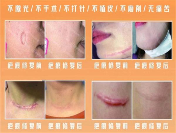 巴敏荟除疤加盟