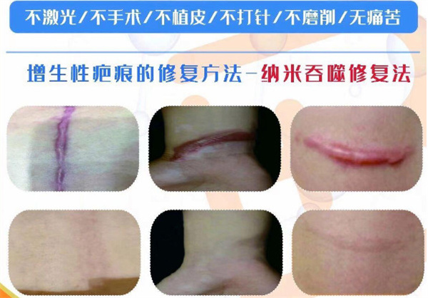 巴敏荟除疤加盟